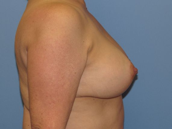 after breast lift no implants left side view female patient case 6885
