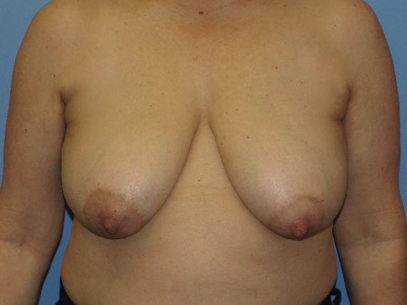 before breast lift no implants front view female patient case 6885