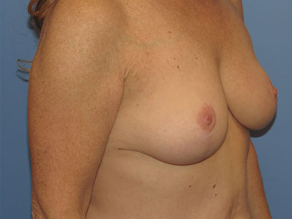 after breast lift no implants right angle view female patient case 6946