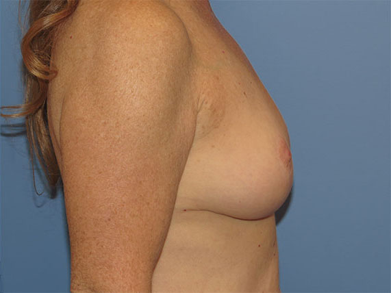 after breast lift no implants right side view female patient case 6946