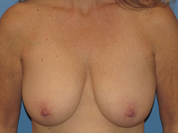 before breast lift no implants front view female patient case 6946