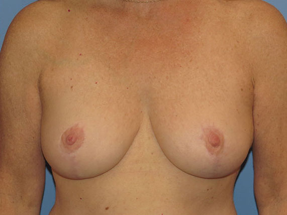 after breast lift no implants front view female patient case 6946
