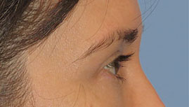 after eyelid surgery right side view female patient case 6961