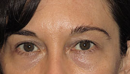 before eyelid surgery front view female patient case 6961