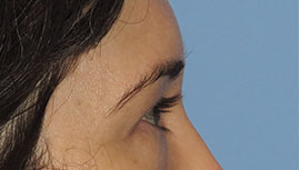 before eyelid surgery right side view female patient case 6961