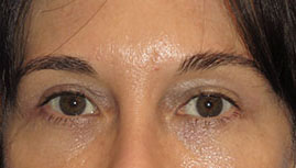 after eyelid surgery front view female patient case 6961